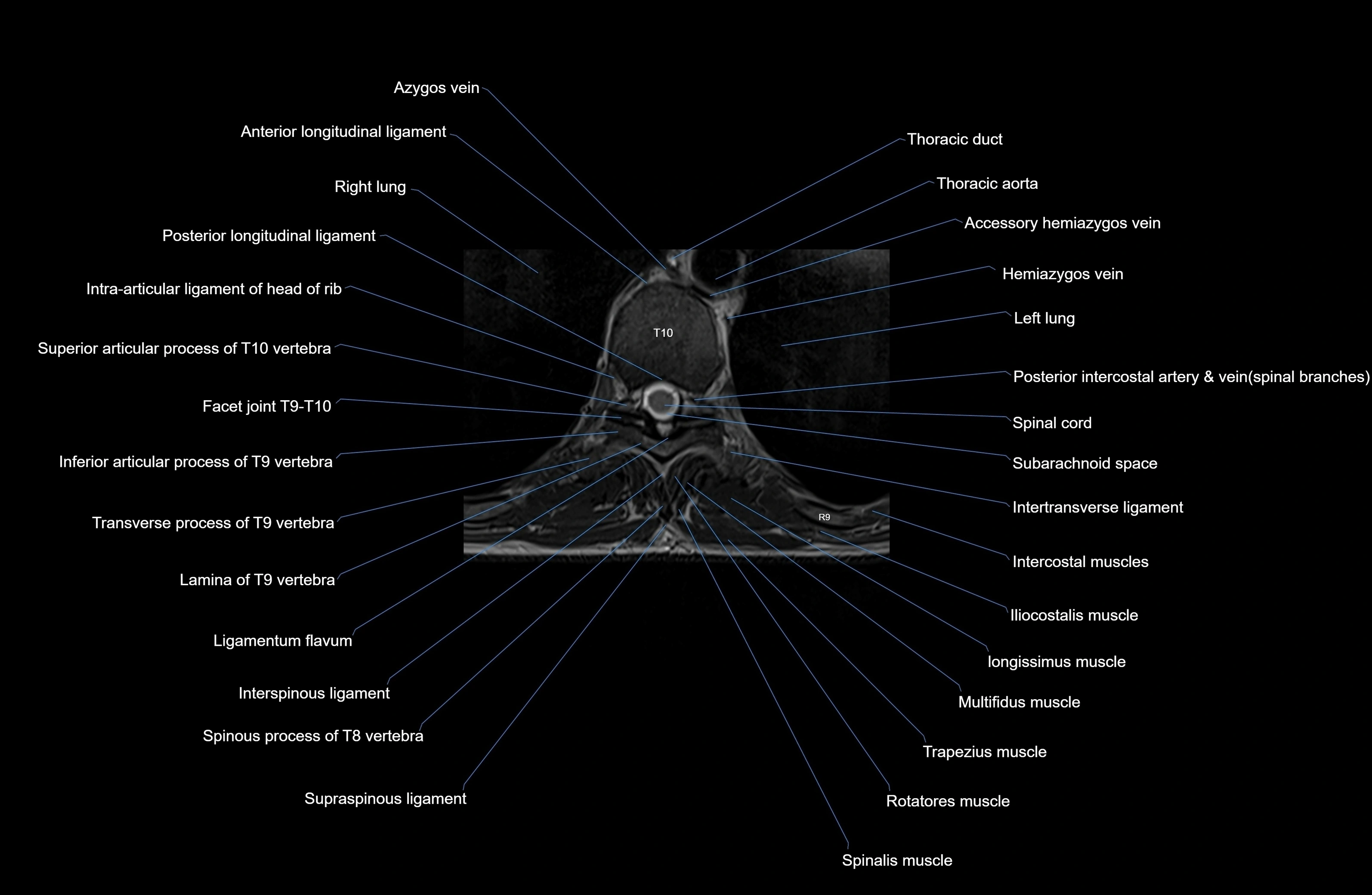 MRI thoracic spine axial  cross sectional anatomy 3T radiology  image-img-00001-00062.webp